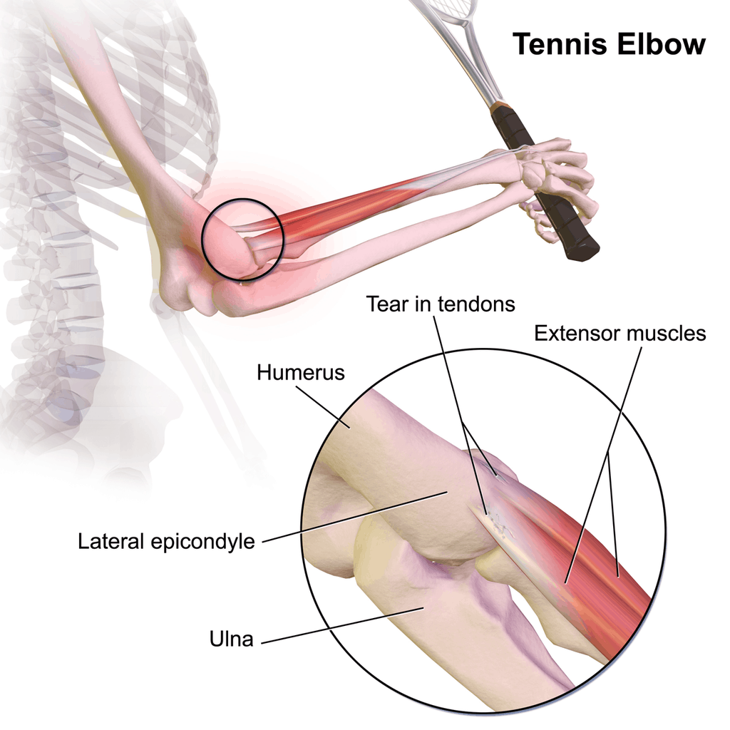 cause of tennis elbow