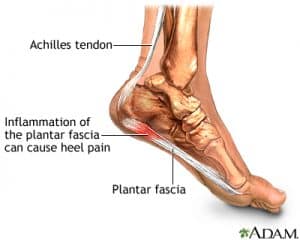 cause of plantar fasciitis